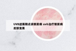 UVB進展期點滴銀屑病 uvb治療銀屑病皮膚變黑