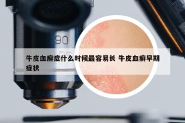 牛皮血癬癥什么時(shí)候最容易長(zhǎng) 牛皮血癬早期癥狀