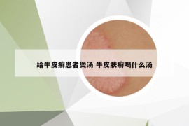 給牛皮癬患者煲湯 牛皮膚癬喝什么湯