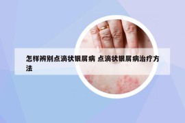 怎樣辨別點(diǎn)滴狀銀屑病 點(diǎn)滴狀銀屑病治療方法