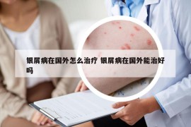 銀屑病在國外怎么治療 銀屑病在國外能治好嗎