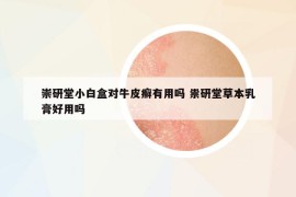 崇研堂小白盒對牛皮癬有用嗎 祟研堂草本乳膏好用嗎