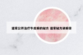 道家公開治療牛皮癬的秘方 道家秘方頑癬膏