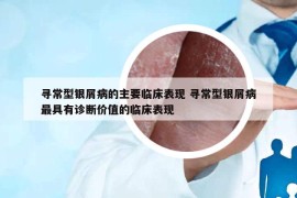 尋常型銀屑病的主要臨床表現(xiàn) 尋常型銀屑病最具有診斷價(jià)值的臨床表現(xiàn)