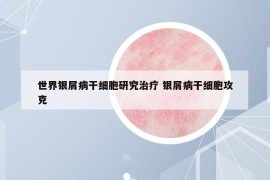 世界銀屑病干細胞研究治療 銀屑病干細胞攻克
