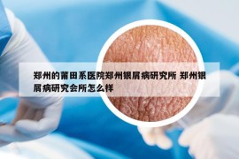 鄭州的莆田系醫(yī)院鄭州銀屑病研究所 鄭州銀屑病研究會所怎么樣