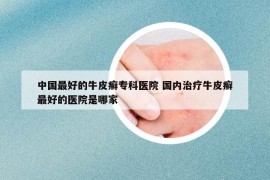 中國(guó)最好的牛皮癬專科醫(yī)院 國(guó)內(nèi)治療牛皮癬最好的醫(yī)院是哪家