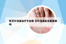陳艾葉泡澡治療牛皮癬 艾葉泡澡能治銀屑病嗎