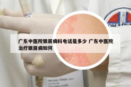 廣東中醫(yī)院銀屑病科電話是多少 廣東中醫(yī)院治療銀屑病如何