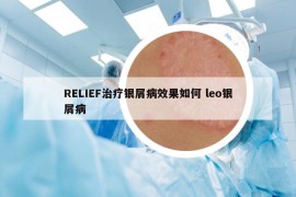 RELIEF治療銀屑病效果如何 leo銀屑病