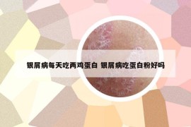 銀屑病每天吃兩雞蛋白 銀屑病吃蛋白粉好嗎