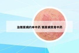 治銀屑病約申中藥 銀屑病常用中藥