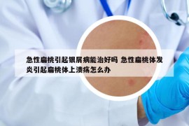 急性扁桃引起銀屑病能治好嗎 急性扁桃體發(fā)炎引起扁桃體上潰瘍怎么辦