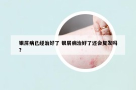 銀屑病已經(jīng)治好了 銀屑病治好了還會(huì)復(fù)發(fā)嗎?