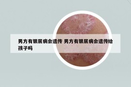 男方有銀屑病會遺傳 男方有銀屑病會遺傳給孩子嗎