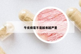 牛皮癬是不是越來越嚴(yán)重
