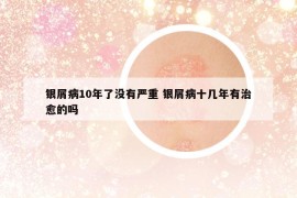 銀屑病10年了沒有嚴(yán)重 銀屑病十幾年有治愈的嗎