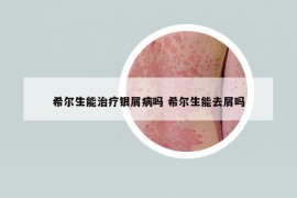 希爾生能治療銀屑病嗎 希爾生能去屑嗎