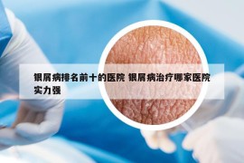 銀屑病排名前十的醫(yī)院 銀屑病治療哪家醫(yī)院實(shí)力強(qiáng)