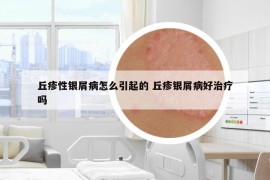 丘疹性銀屑病怎么引起的 丘疹銀屑病好治療嗎