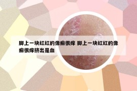 腳上一塊紅紅的像癬很癢 腳上一塊紅紅的像癬很癢擠出是血