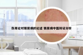 傷寒論對(duì)銀屑病的論述 銀屑病中醫(yī)辯證分析