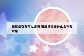 銀屑病交友可以吃嗎 銀屑病能吃什么食物和水果