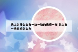 頭上為什么會(huì)有一塊一塊的像癬一樣 頭上有一塊頭癬怎么辦