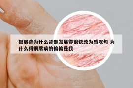 銀屑病為什么背部發(fā)展得很快改為感嘆句 為什么得銀屑病的偏偏是我
