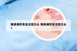 銀屑病飲食應(yīng)注意什么 銀屑病飲食注意什么?