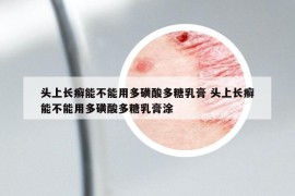 頭上長(zhǎng)癬能不能用多磺酸多糖乳膏 頭上長(zhǎng)癬能不能用多磺酸多糖乳膏涂
