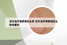 豆方治療銀屑病怎么樣 豆方治療銀屑病怎么樣效果好