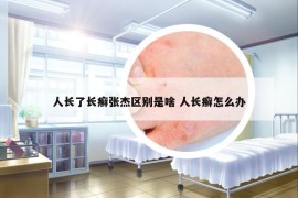 人長了長癬張杰區(qū)別是啥 人長癬怎么辦