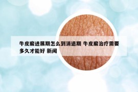 牛皮廨進展期怎么到消退期 牛皮廨治療需要多久才能好 新聞