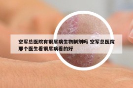 空軍總醫(yī)院有銀屑病生物制劑嗎 空軍總醫(yī)院那個醫(yī)生看銀屑病看的好