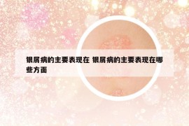 銀屑病的主要表現(xiàn)在 銀屑病的主要表現(xiàn)在哪些方面