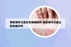 銀屑病可以查出發(fā)病病因嗎 銀屑病可以通過驗(yàn)血確診嗎