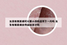 女孩有銀屑病可以要小孩嗎遺傳下一代嗎 女生有銀屑病會傳染給孩子嗎