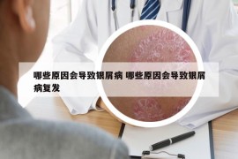 哪些原因會導致銀屑病 哪些原因會導致銀屑病復發(fā)