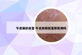牛皮癬的皮是 牛皮膚癬就是銀屑病嗎