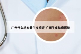 廣州什么地方看牛皮癬好 廣州牛皮膚癬醫(yī)院