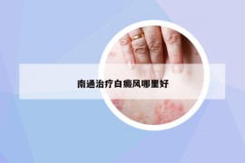 南通治療白癜風(fēng)哪里好