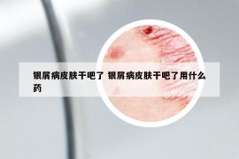 銀屑病皮膚干吧了 銀屑病皮膚干吧了用什么藥