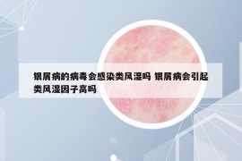 銀屑病的病毒會(huì)感染類風(fēng)濕嗎 銀屑病會(huì)引起類風(fēng)濕因子高嗎