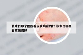張家口那個(gè)醫(yī)院看皮膚病看的好 張家口哪里看皮膚病好