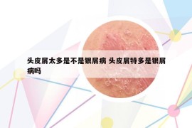 頭皮屑太多是不是銀屑病 頭皮屑特多是銀屑病嗎