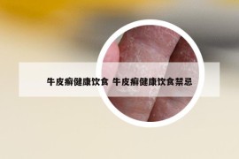 牛皮癬健康飲食 牛皮癬健康飲食禁忌