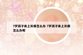 7歲孩子身上長(zhǎng)癬怎么辦 7歲孩子身上長(zhǎng)癬怎么辦呢