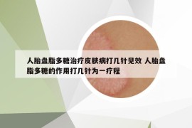 人胎盤(pán)脂多糖治療皮膚病打幾針見(jiàn)效 人胎盤(pán)脂多糖的作用打幾針為一療程