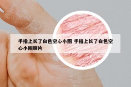 手指上長了白色空心小圈 手指上長了白色空心小圈照片